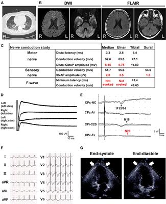 Case Report: Takotsubo Cardiomyopathy in Bickerstaff Brainstem Encephalitis Triggered by COVID-19